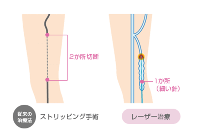 ストリッピング手術とレーザー治療